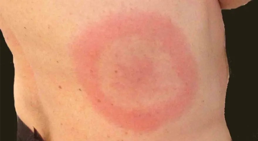 Rodnad ring på huden, som om det vore knottrig hud som kliar. Ser ut som ett bett.
