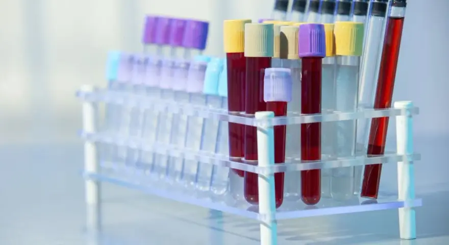 Rurki z krwią w stojaku laboratoryjnym. Czy to badanie CA 125?
