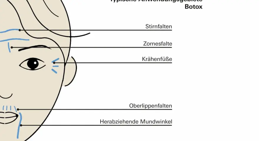 Schema zeigt typische Anwendungsgebiete für Botox, z.B. Stirnfalten, Zornesfalten, Krähenfüße.