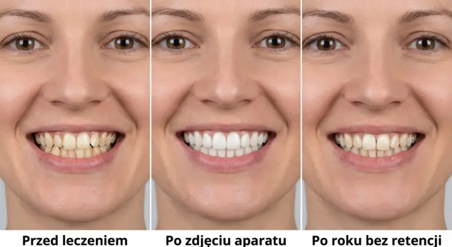 Uśmiech przed leczeniem, po zdjęciu aparatu i po roku bez retencji. Aparat retencyjny pomaga utrzymać efekt.