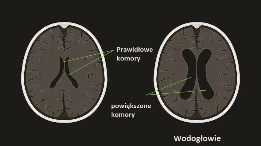 Wodogłowie u niemowląt: objawy, leczenie i co robić, gdy podejrzewasz?