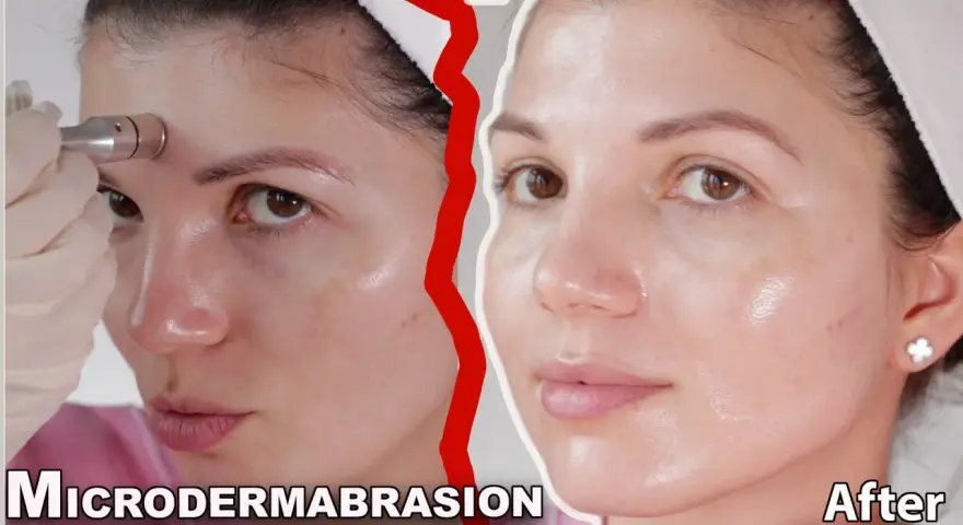 Woman using a microdermabrasion device on her forehead. Learn how to clean microdermabrasion tips for best results.