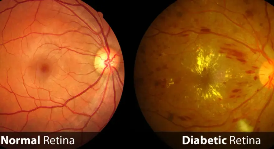 Confronto tra retina sana e retina diabetica: la seconda mostra emorragie e depositi gialli, sintomi della retinopatia diabetica.