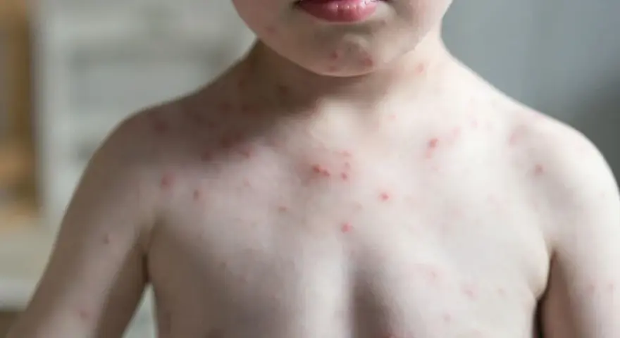 Kind mit roten Pusteln am Oberkörper und Hals. Die Haut wirkt blass, was Fragen aufwirft: "Warum ist mein Kind so blass?