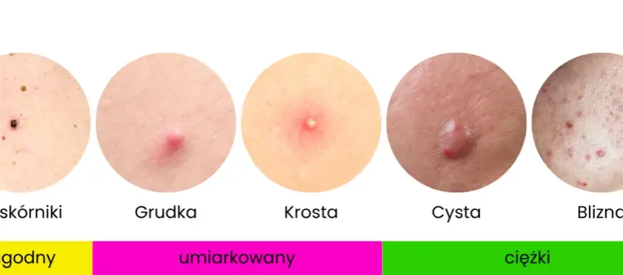 Cera trądzikowa: Kompleksowy przewodnik po pielęgnacji i leczeniu