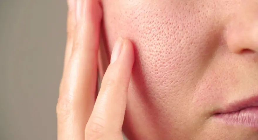 Gros plan sur une peau avec un pore dilaté visible, touchée par une main.