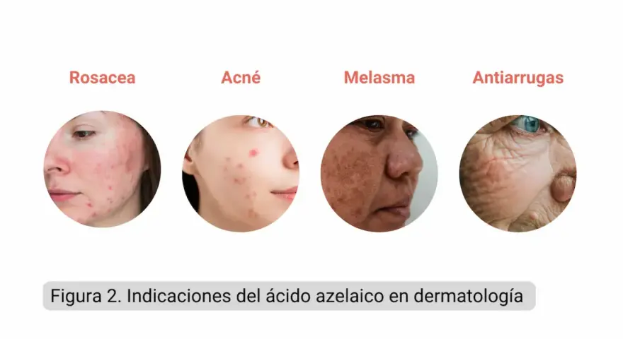 El ácido azelaico sirve para tratar rosácea, acné, melasma y arrugas, mostrando su versatilidad en dermatología.