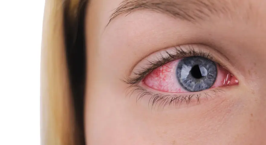 Occhio rosso e irritato, possibile sintomo di clamidia.
