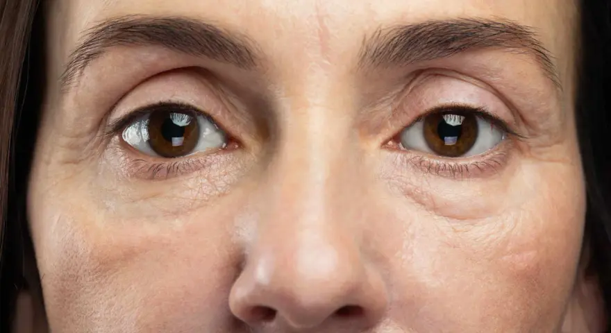 Nahaufnahme eines Gesichts, das schlaffe Haut unter den Augen zeigt, mit feinen Linien und Falten, die die Spuren der Zeit erzählen.