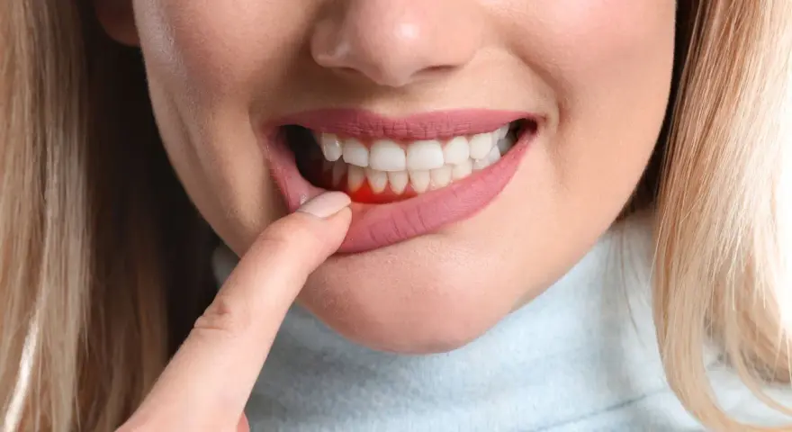 Wyrwanie zęba: Gojenie dziąsła krok po kroku. Uniknij suchego zębodołu!