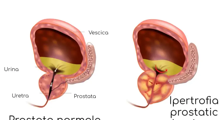Confronto tra prostata normale e prostata infiammata, dove l'ipertrofia prostatica benigna comprime l'uretra, ostacolando il flusso urinario.