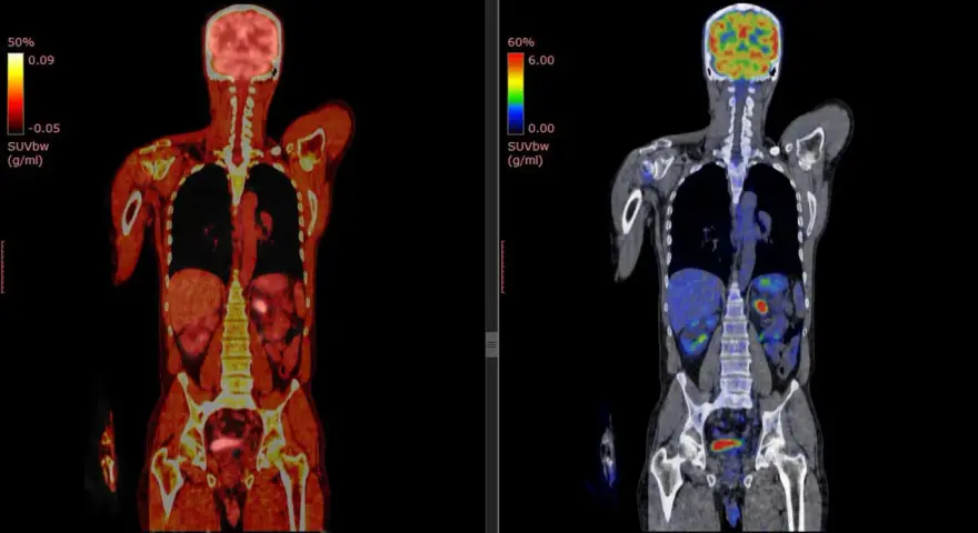Co oznacza SUV w badaniu PET i jak wpływa na diagnozę?
