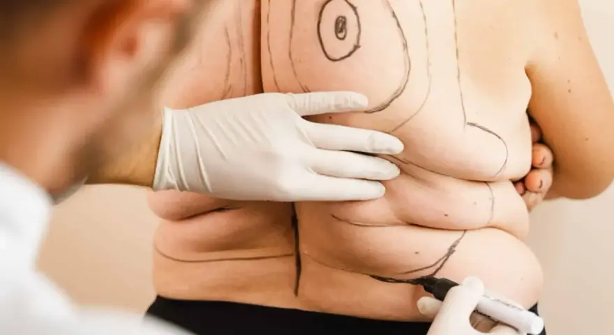 Liposukcja: Co to jest? Zrozum zabieg modelowania sylwetki