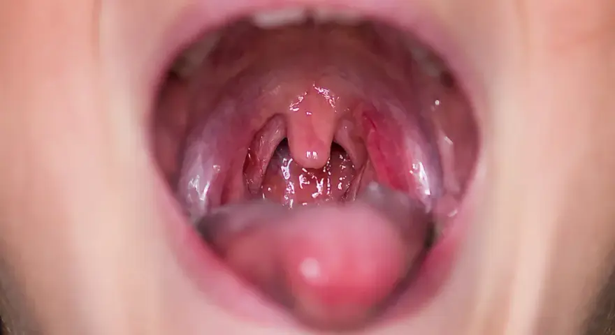 Widok jamy ustnej z widocznym obrzękiem i zaczerwienieniem po jednej stronie, sugerującym ropień okołomigdałkowy.