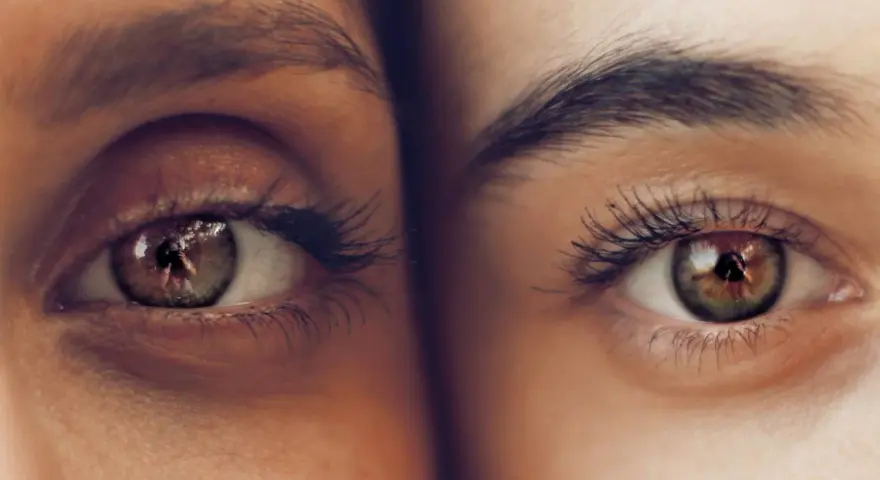 Dos ojos de cerca, uno con ojeras vasculares marcadas, el otro con piel lisa. Reflejos en los iris.
