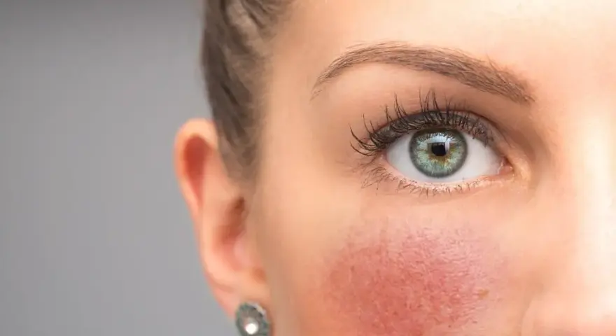 Was tun gegen rote Gesichtshaut? Effektive Tipps und Behandlungen