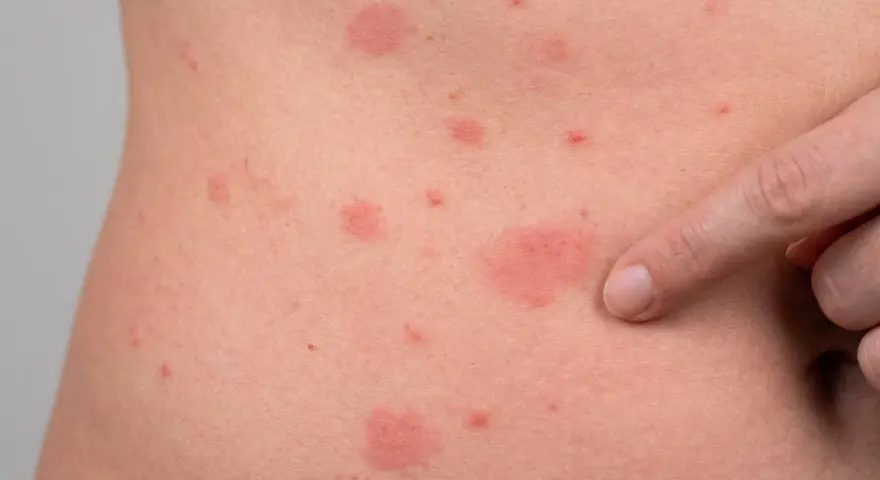 Rote Flecken und Quaddeln auf der Haut, ein deutlicher **ausschlag am bauch**. Ein Finger deutet auf eine der betroffenen Stellen.