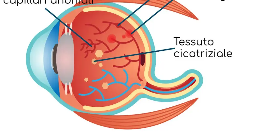 Illustrazione della retinopatia diabetica: sviluppo di capillari anomali, rigonfiamenti, emorragie retiniche che si riassorbono e tessuto cicatriziale.