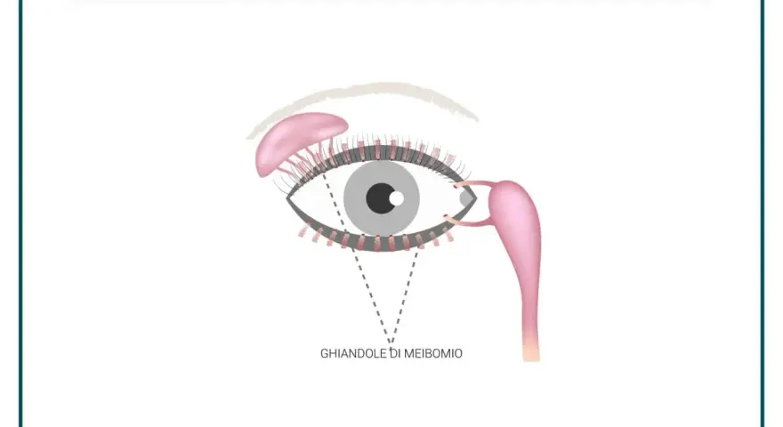 Illustrazione anatomica dell'occhio che evidenzia le ghiandole di Meibomio infiammate, responsabili della produzione del film lacrimale.