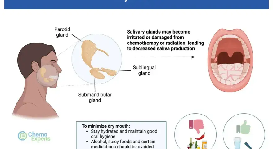 Chemioterapia i radioterapia mogą uszkodzić gruczoły ślinowe, powodując **suche usta**. Unikaj alkoholu i pikantnych potraw.