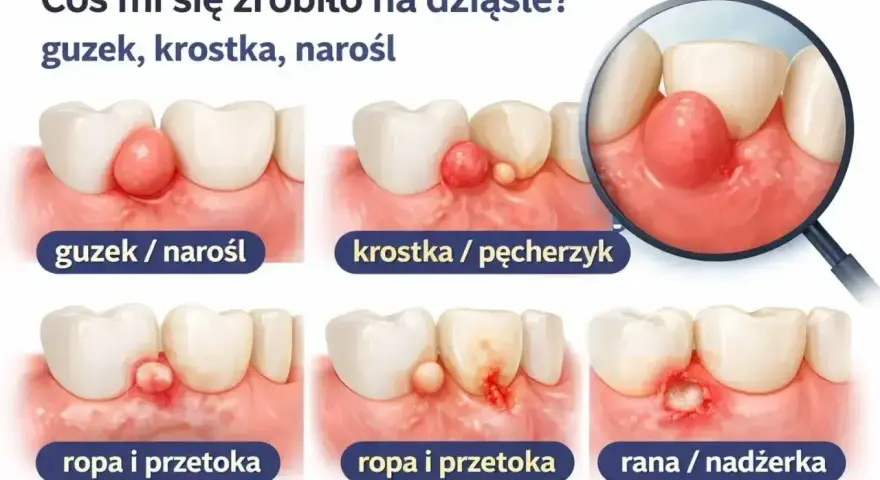 Ilustracja pokazuje zmiany na dziąśle: guzek, krostkę, ropień, z którego może być wyciągana ropa z zęba, aż do rany.