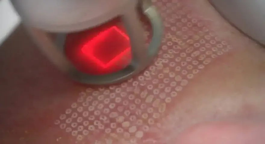 Zabieg laserem frakcyjnym: czerwony promień lasera tworzy na skórze siatkę mikrouszkodzeń. Czy laser frakcyjny boli? Odczucia są indywidualne.