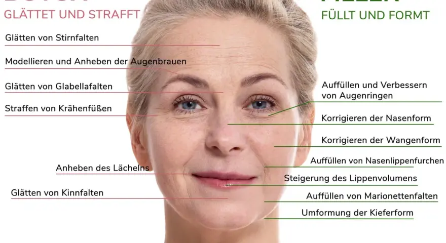 Gesicht einer Frau mit markierten Bereichen für Botox und Filler zur Behandlung von falten im gesicht, Stirnfalten, Krähenfüßen und Marionettenfalten.