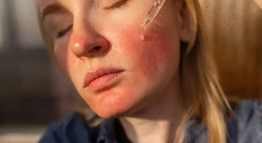Czerwona, podrażniona skóra twarzy po aplikacji serum. Możliwe niacynamid skutki uboczne.