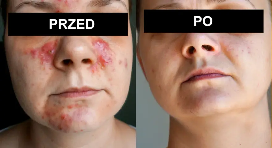 Przed i po: skóra z problemami, widoczne zmiany zapalne, a następnie wygładzona po zastosowaniu kremu na nużeńca.