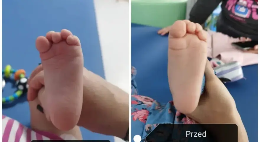 Dwie stopy dziecka, jedna po drugiej. Widać postęp w leczeniu szpotawych stóp.