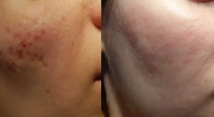 Przed i po zabiegu na blizny po trądziku. Skóra wyraźnie gładsza, zaczerwienienia zniknęły.
