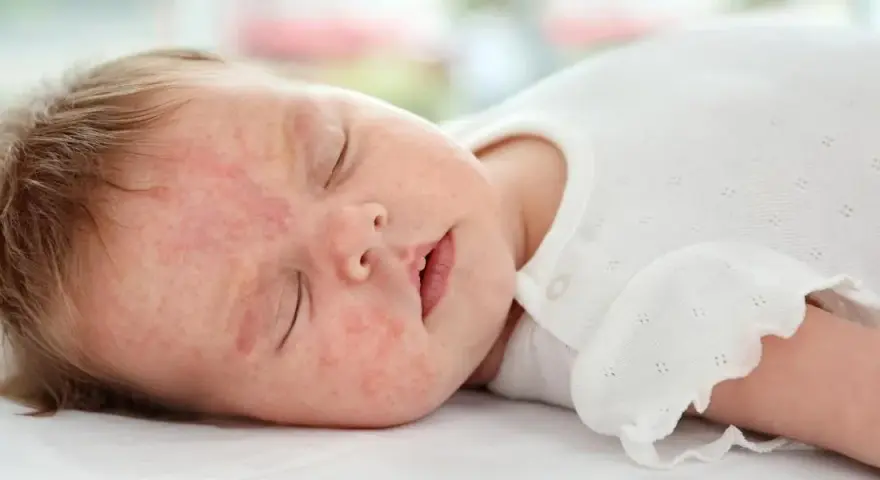 Alergia u niemowlaka objawy – jak je rozpoznać i co zrobić?