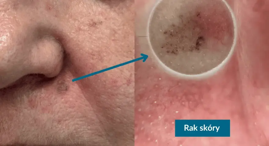 Zmiana na skórze, która wygląda jak pieprzyk na policzku, powiększona pod dermatoskopem.