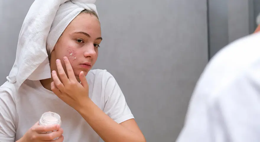 Mädchen mit Handtuch auf dem Kopf trägt Zinksalbe auf Pickel im Gesicht auf.