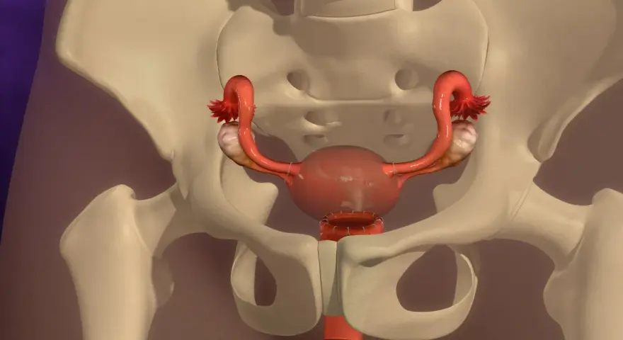 Anatomical model showing the female reproductive system within the pelvis. The uterus has undergone usunięcie macicy, with sutures visible at the cervical stump.