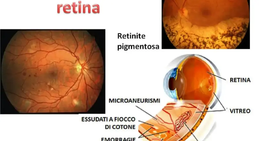 Immagini di malattie retiniche, tra cui la retinite pigmentosa e la retinopatia diabetica, che mostrano difetti dell'epitelio pigmentato retinico, emorragie e vasi sanguigni alterati.