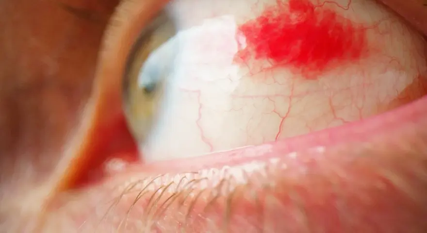 Un occhio umano con la sclera arrossata e una macchia di sangue visibile. Le ciglia sono sfocate in primo piano, mentre l'iride verde-marrone è parzialmente visibile.