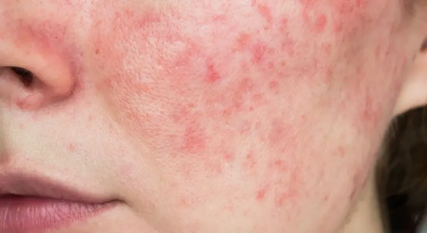 Primo piano del viso con evidenti rossori e imperfezioni cutanee, che suggeriscono una condizione come la rosacea o l'acne.
