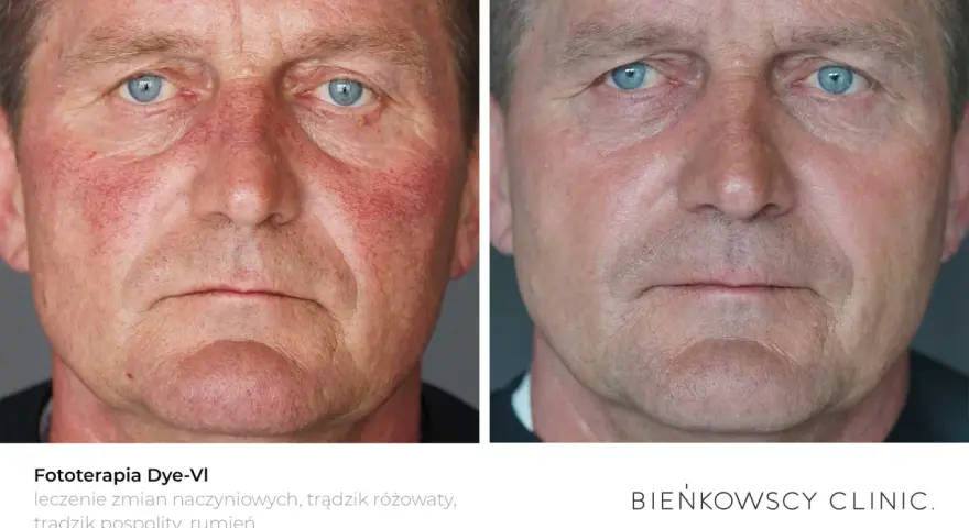 Przed i po fototerapii Dye-VI: widoczna poprawa rumienia i zmian naczyniowych, skuteczna w leczeniu trądziku różowatego u mężczyzn.