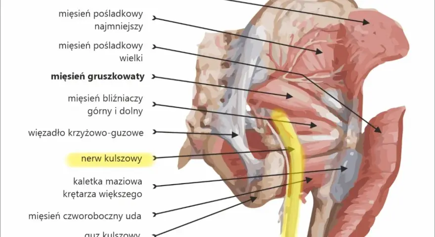 Anatomia miednicy: wbicie igły w nerw kulszowy, przebiegający obok mięśnia gruszkowatego.