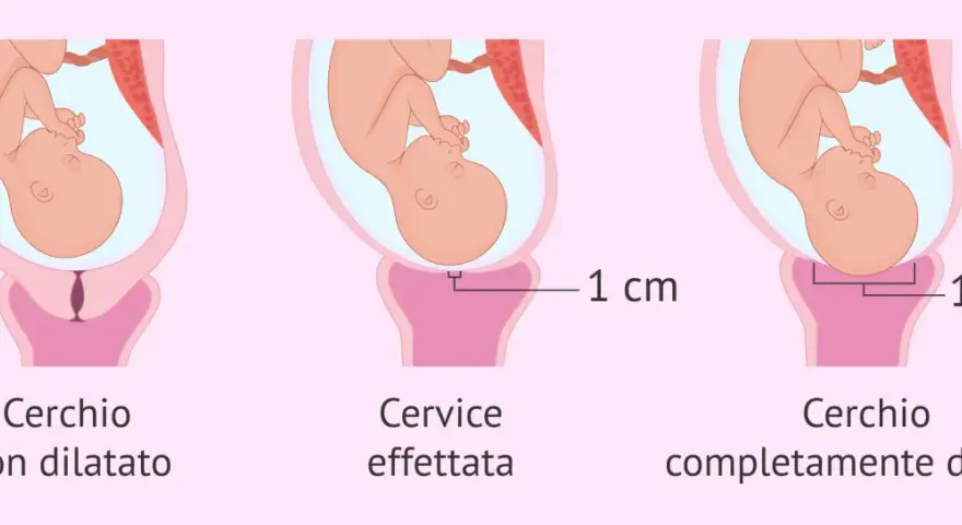 Illustrazione del nono mese di gravidanza: utero con feto, cervice non dilatata, dilatata 1 cm e completamente dilatata (10 cm).