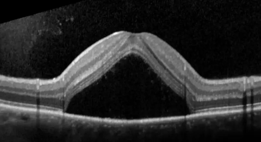 OCT di occhio con corioretinopatia sierosa centrale. Evitare stress e cortisone per non peggiorare la condizione.