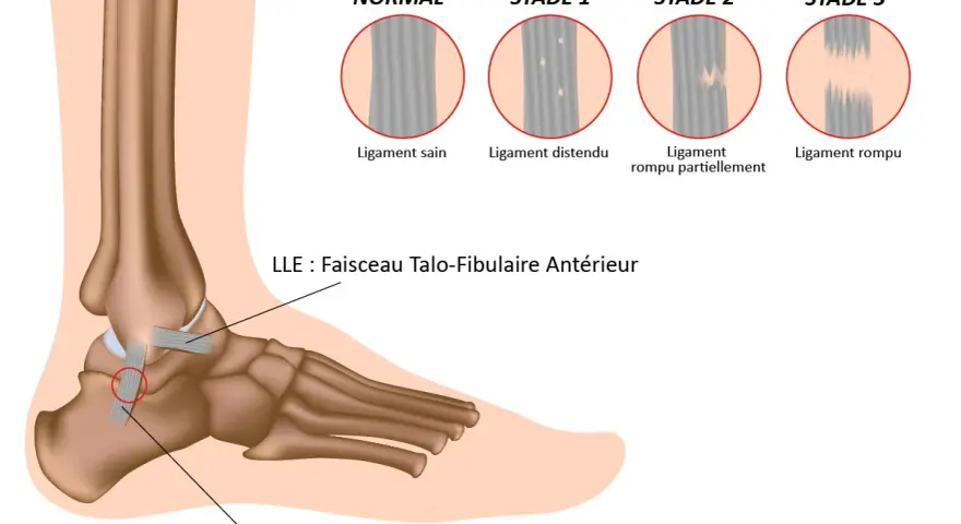 Illustration des différents stades d'une entorse du pied, du ligament sain au ligament rompu.