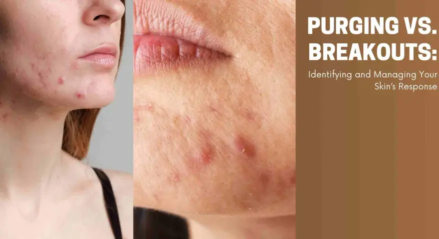 Close-up of a face with acne, showing breakouts after starting a new skincare routine. Text reads "PURGING VS. BREAKOUTS: Identifying and Managing Your Skin's Response.
