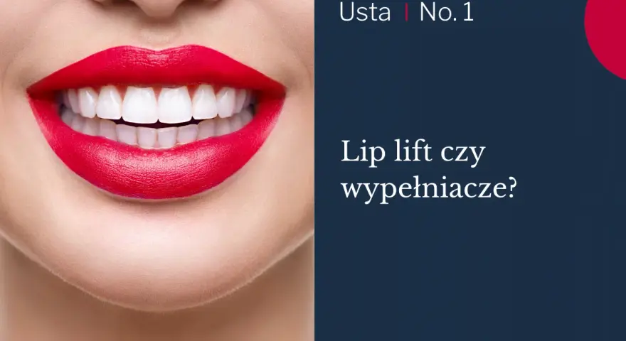 Usta po zabiegu lip lift, z idealnie białymi zębami i czerwonymi ustami.