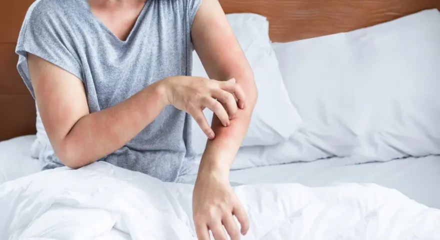 Frau kratzt sich am Arm, rote Hautstellen. Juckende Haut kann ein Symptom der Wechseljahre sein.