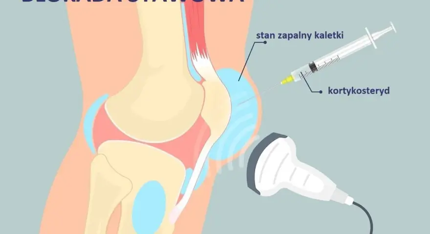 Ilustracja przedstawia blokadę stawową kolana. Zastrzyki w kolano z kortykosteroidem pod kontrolą USG pomagają przy stanie zapalnym kaletki.