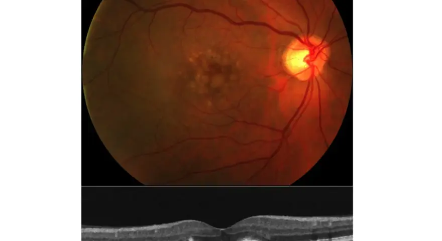 Immagine OCT e fondo oculare che mostrano segni di degenerazione maculare, il cui significato è cruciale per la diagnosi.