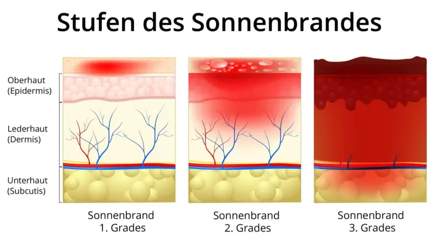 Illustrationen zeigen Hautschichten bei Sonnenbrand 1., 2. und 3. Grades. Der Sonnenbrand 2. Grades zeigt Blasenbildung in der Epidermis und Rötung der Dermis.