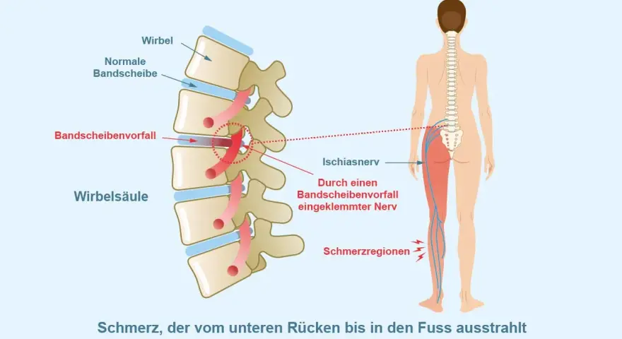 Illustration zeigt Bandscheibenvorfall, der Ischiasnerv reizt. Schmerz strahlt vom Rücken ins Bein aus. Mögliche Linderung durch Ischias Medikamente.